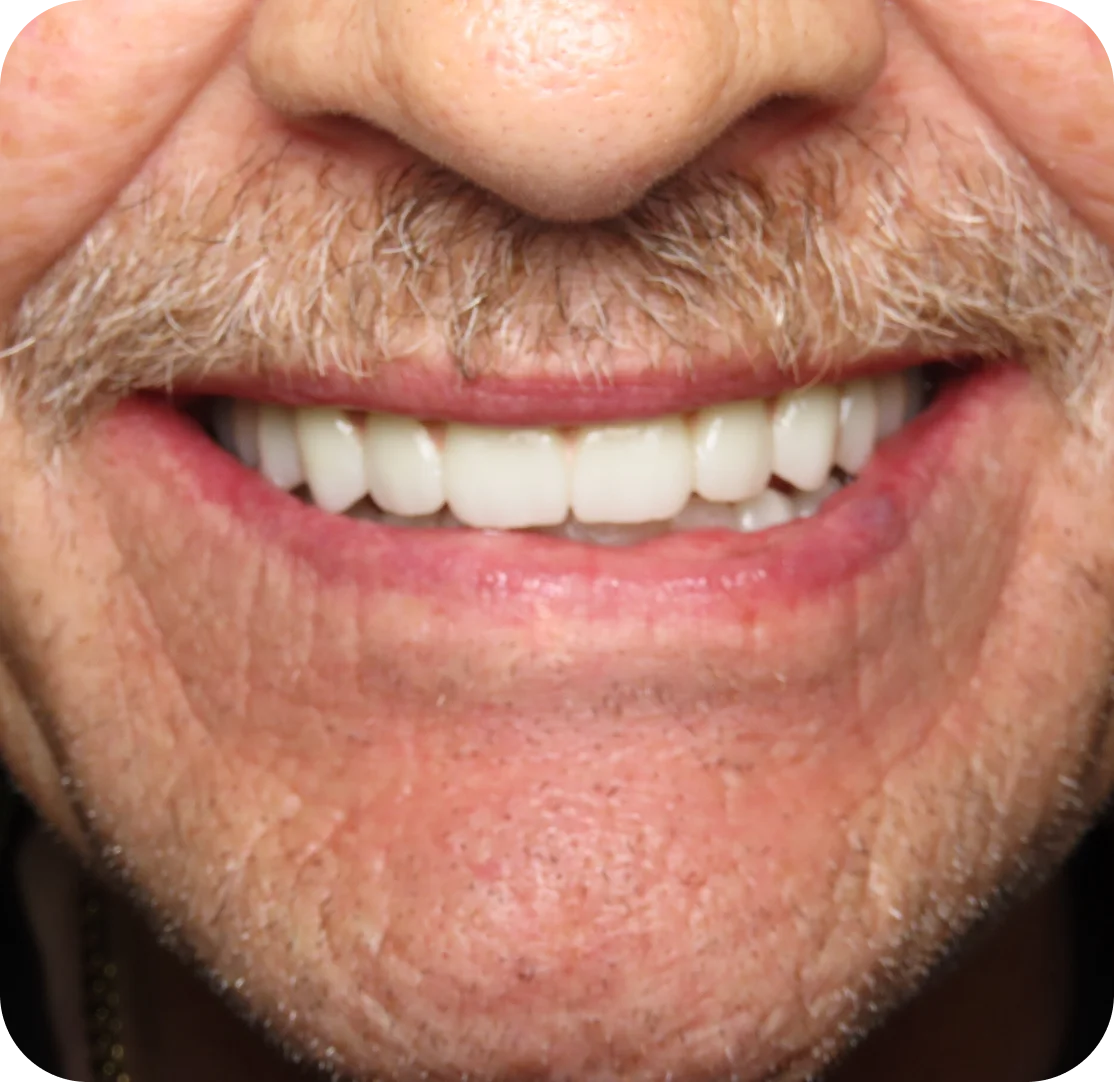 What Is All-on-X Dental Implant Treatment?