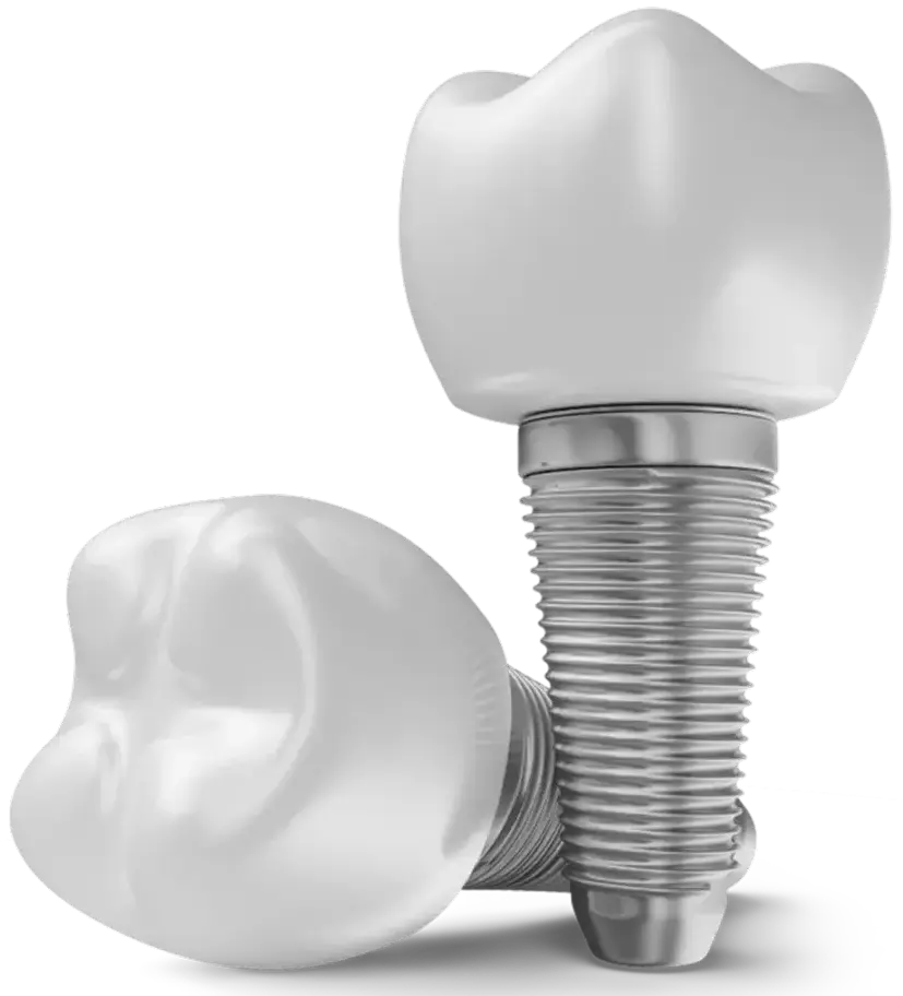 Full Arch Implant Centres in Metro Vancouver