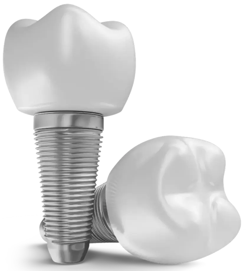 Full Arch Implant Centres in Metro Vancouver